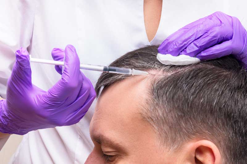 Hair Plasma: tratamiento frenar la caída del cabello asociada a la Covid-19