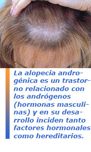 alopecia femenina