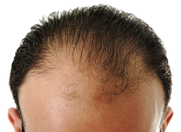 Cómo detectar la alopecia y cuándo recomendar una cirugía capilar