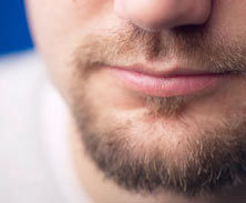 El implante de barba está de moda