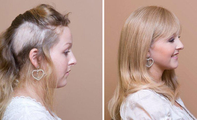 La tricotilomanía: síntomas, tratamiento y complicaciones