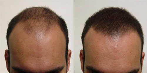 K-Max Keratin Maximation