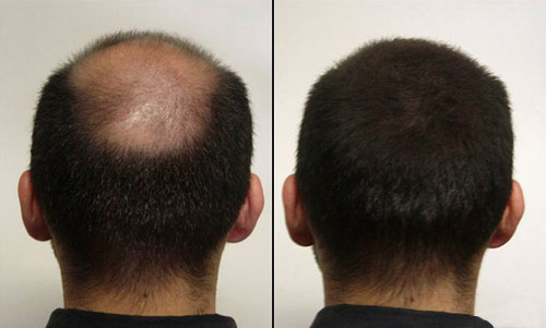 K-Max Keratin Maximation