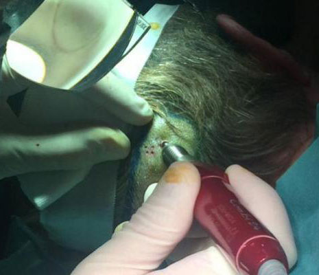 Primera unidad de trasplante capilar reconstructivo de la Sanidad española