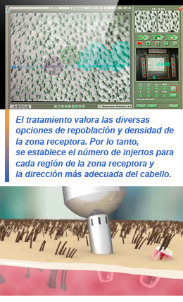 Artas, tecnología robótica para trasplante capilar