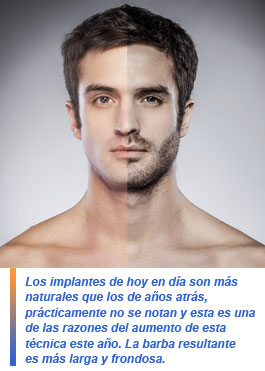implantes de barba