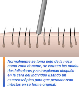 implantes de barba