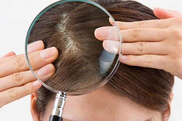 El cuero cabelludo necesita cuidados especiales