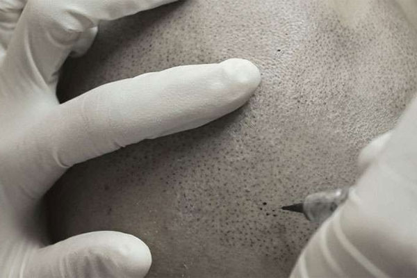 Micropigmentación capilar, el efecto 'cabeza afeitada' más natural